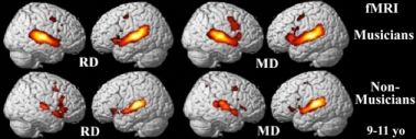 the active areas in the brain show clearly that a larger portion of the brain is activated in children with musical training